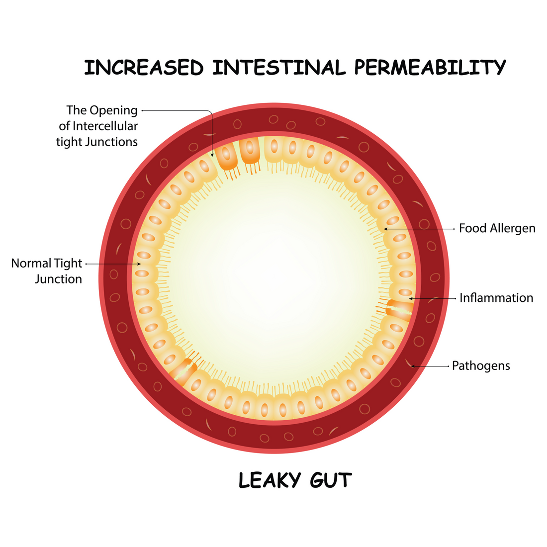 Leaky Gut Syndrome